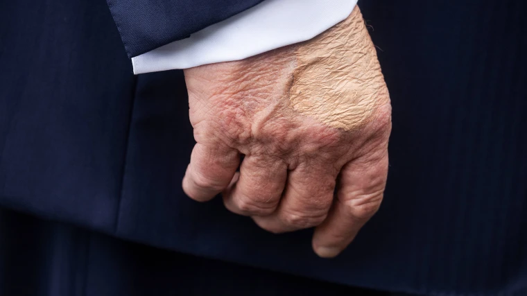 Donald Trump’s Chronic Venous Insufficiency Diagnosis: What It Means and Why It’s Not Life-Threatening